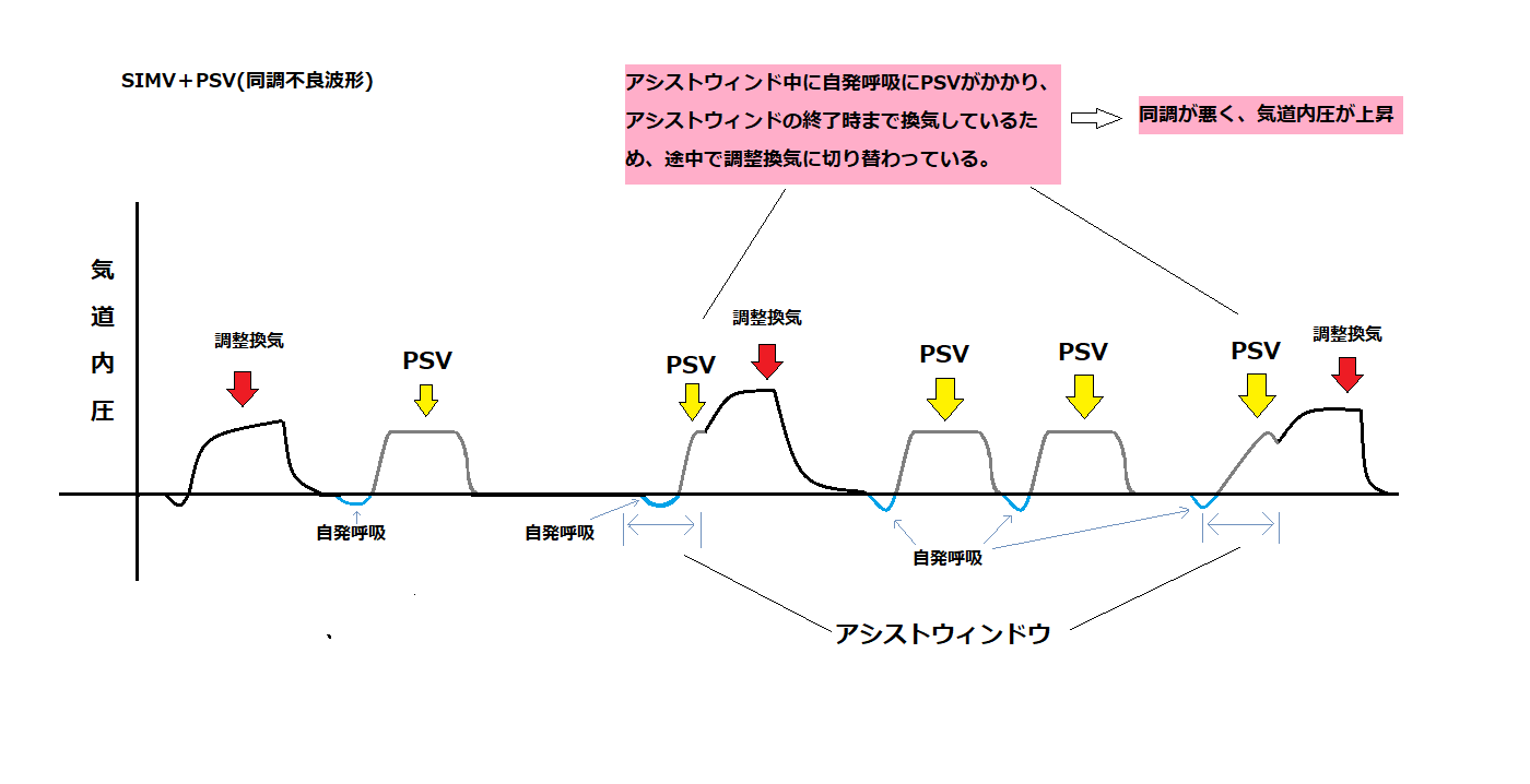 人工呼吸器_SIMV_PSV_同調不良波形