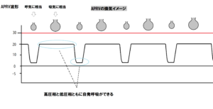 人工呼吸器_APRVの換気イメージ