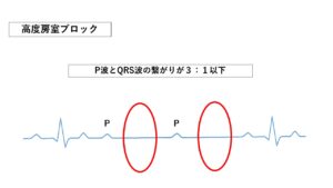 ペースメーカー_心電図_高度房室ブロック